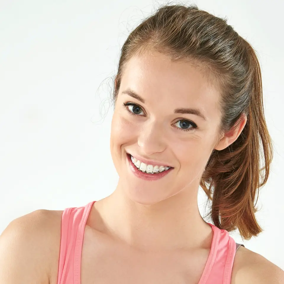 Tooth colored braces
