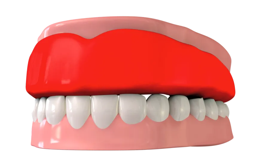Der Sportmundschutz schützt die obere Zahnreihe - Darstellung anhand eines Modells